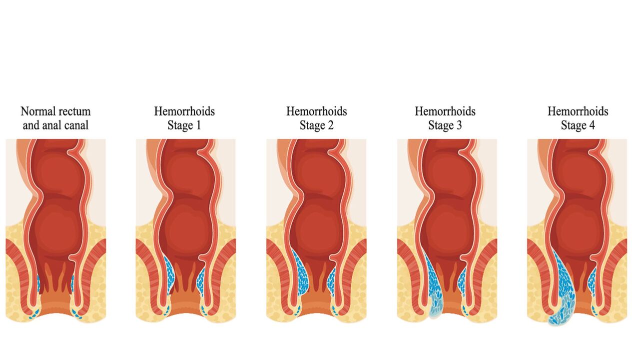 Zorte vun hemorrhoids