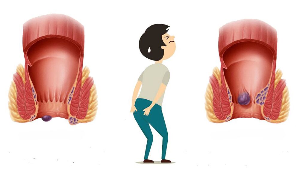 hemorrhoid Symptomer